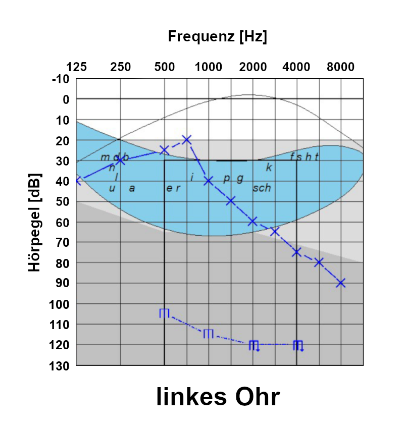Audiogramm linkes Ohr: bis 1000 Hertz Hör-Schwelle zwischen 20 und 40 Dezibel. Ab 1500 Hertz Hör-Schwelle sinkend bis auf 90 Dezibel bei 8000 Hertz.