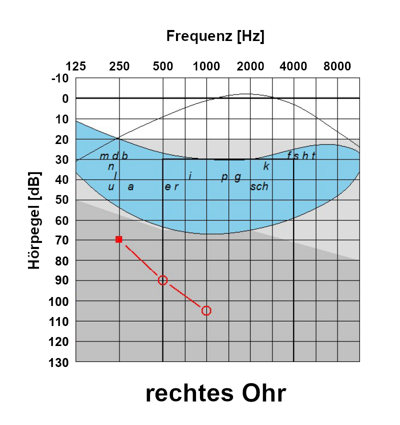 Audiogramm rechtes Ohr: Rest-Hör-Vermögen bei 500 bis 1000 Hertz. Hör-Schwelle hier bei 90 bis 110 Dezibel.